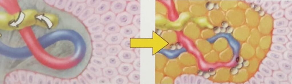 lipoedeem process